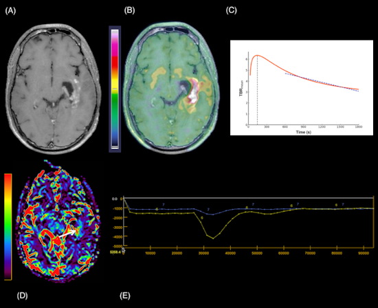 A 24 year old man with a suspected GIII anaplastic astrocytoma IDH mutant recurrence