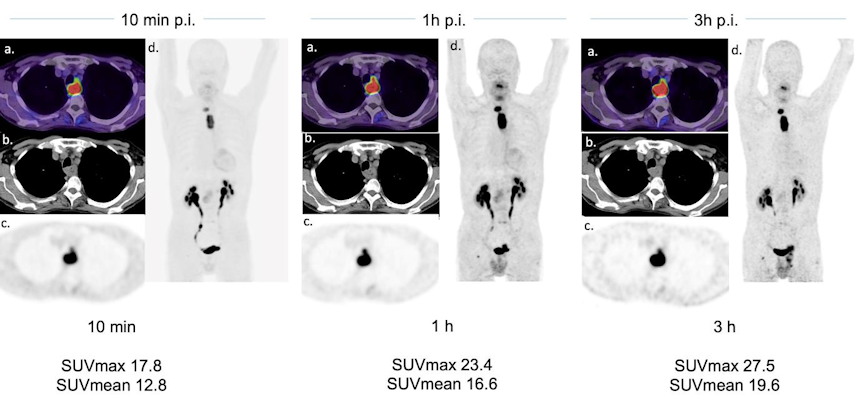 A case example of a 63 year old patient with esophageal cancer