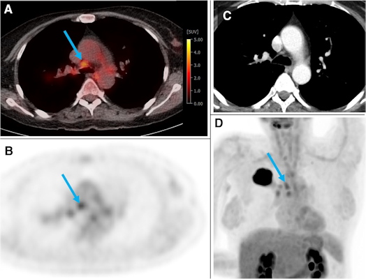 A 54 year old woman from the training and test cohort with a G2 adenocarcinoma of the right upper lobe