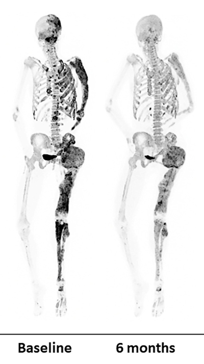 PET bone scans of a patient before and after a six-month denosumab treatment show reduced turnover within fibrous dysplasia lesions