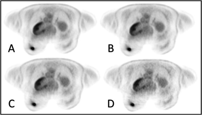 PET images of a 54 year old breast cancer patient with a good subjective image quality score